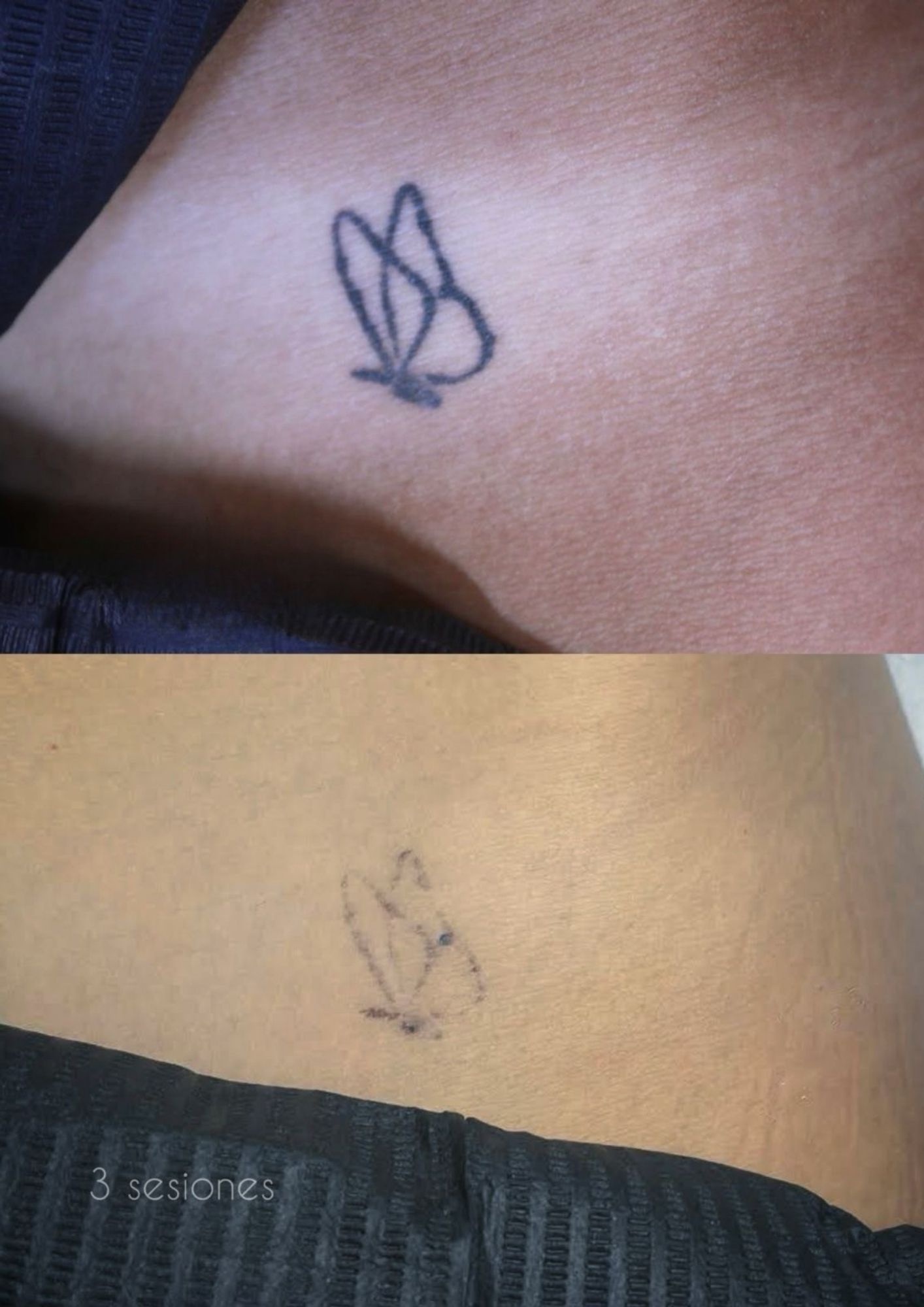 Borrado de tatuaje de mariposa en hombro después de 3 sesiones