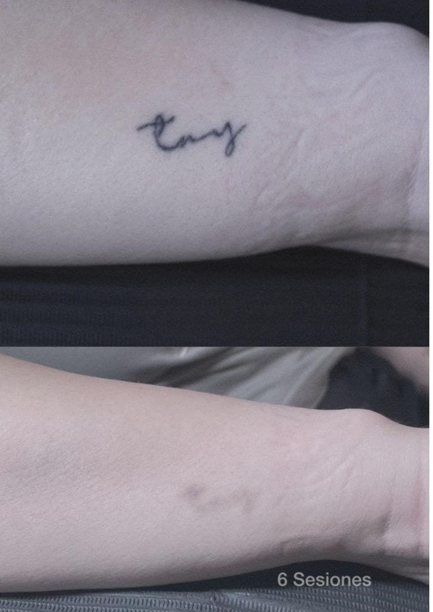 Borrado de tatuaje de letras en muñeca después de 6 sesiones