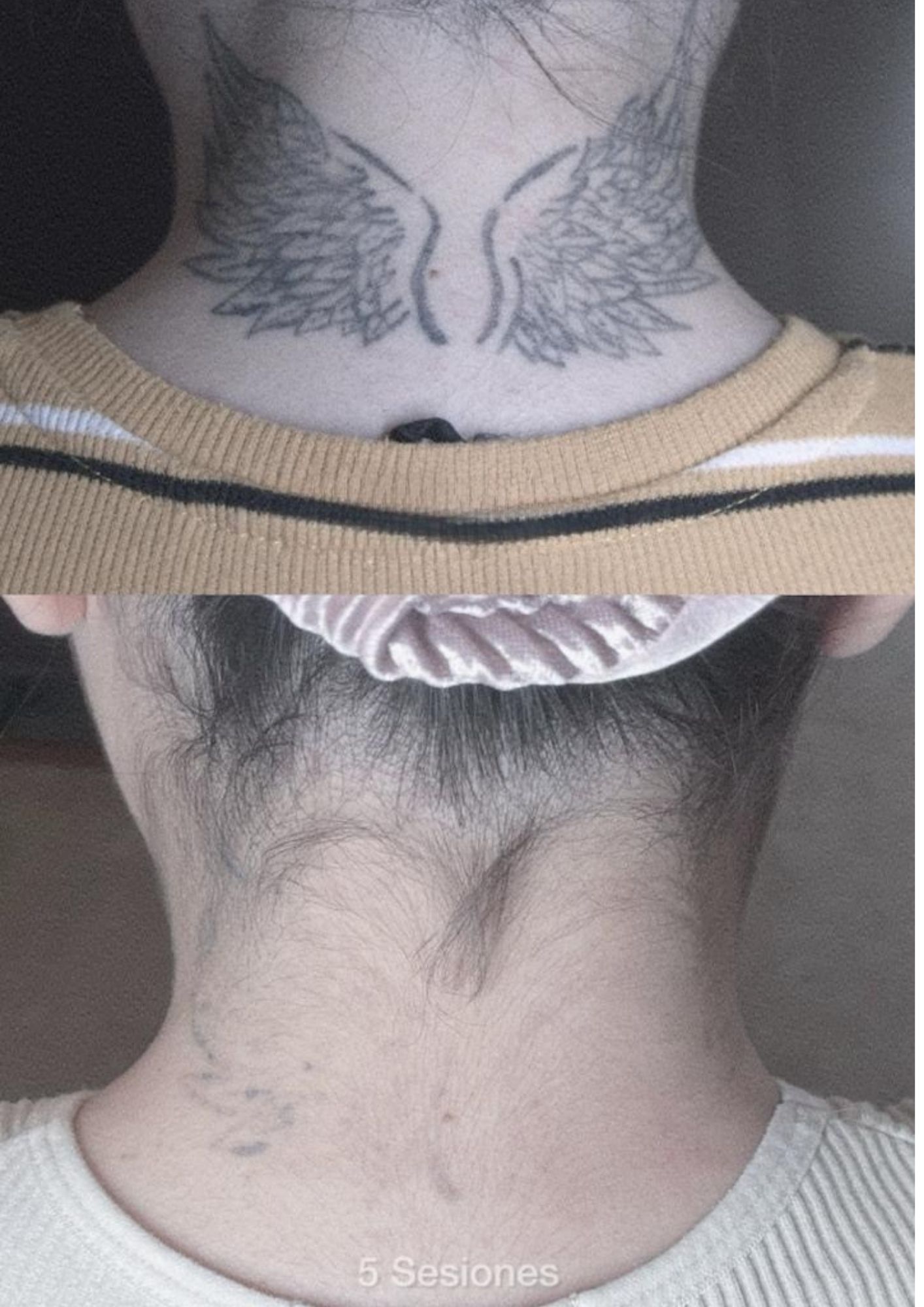 Borrado de tatuaje de alas en cuello después de 5 sesiones