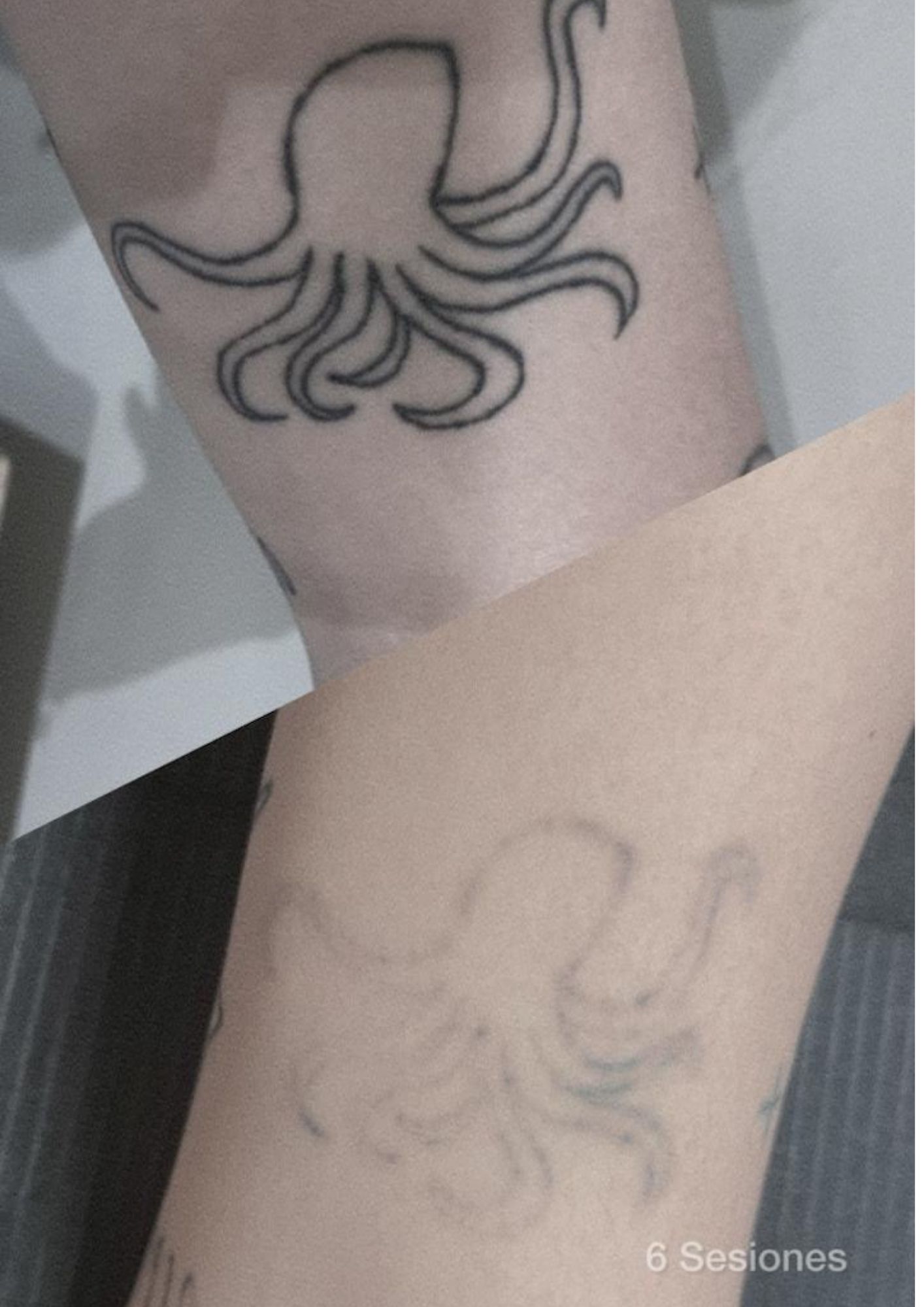 Borrado de tatuaje de pulpo en brazo después de 6 sesiones