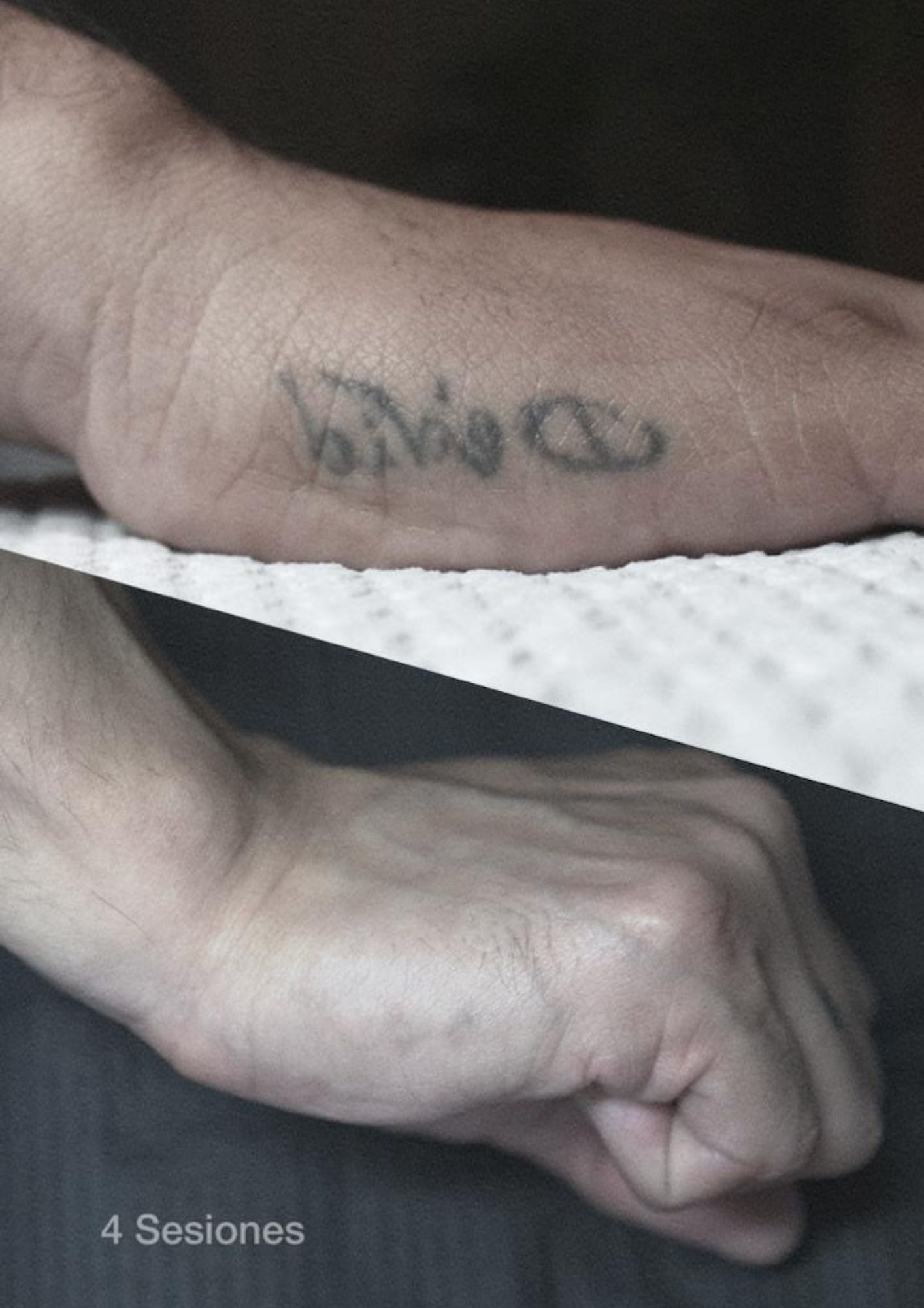 Borrado de tatuaje de letras en mano después de 4 sesiones