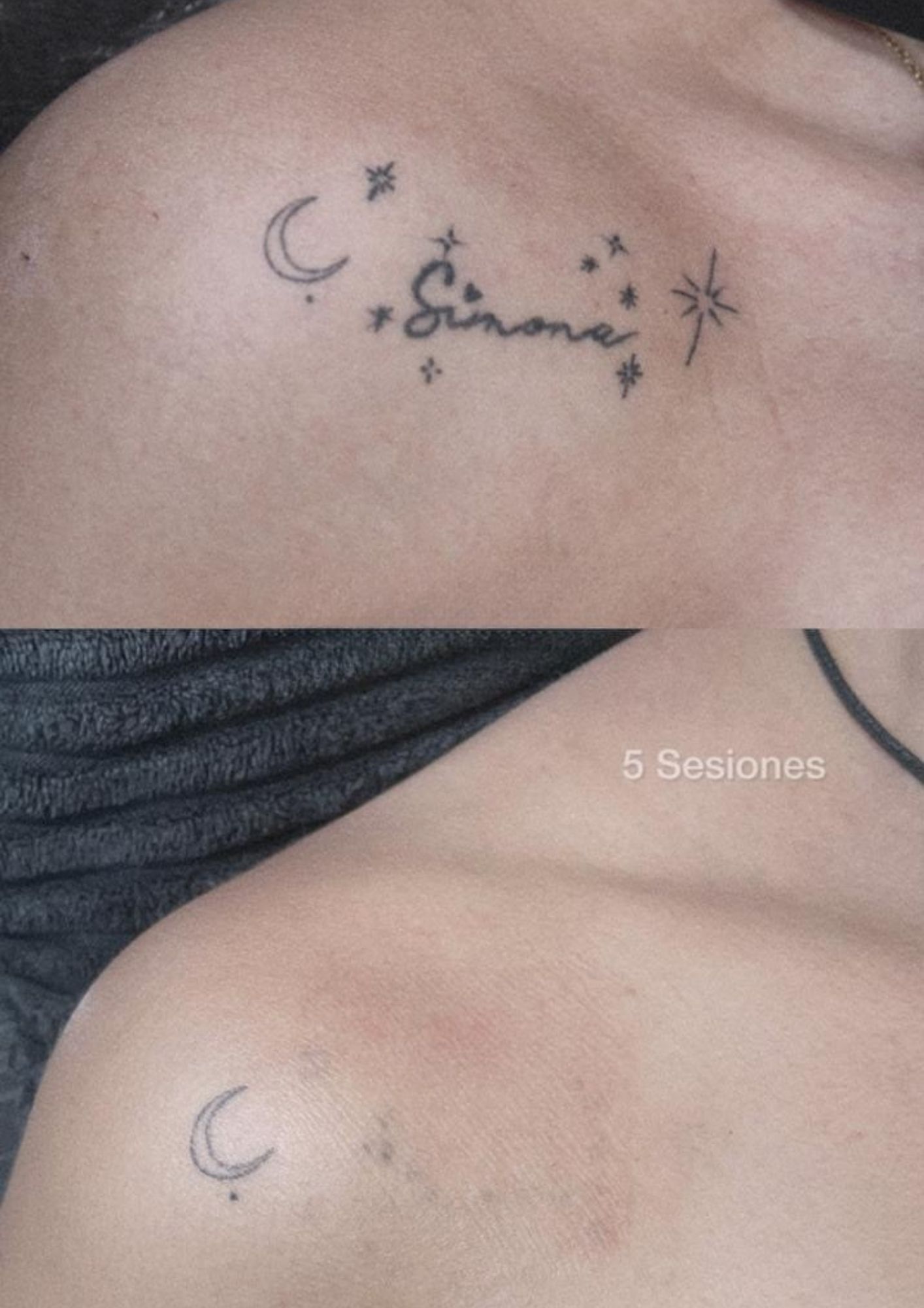 Borrado de tatuaje de luna y estrellas en hombro después de 5 sesiones